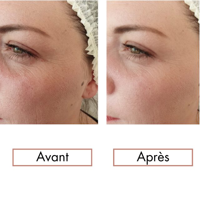 Kit Maderothérapie Faciale + automassage en vidéo
